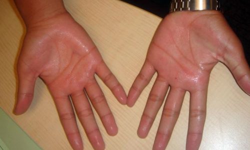 Hyperhidrosis on Your Palms