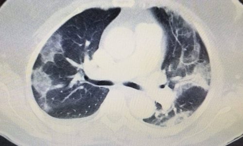 AI for Health: Detecting COVID-19 in Lung Ultrasound Images with Unprecedented Accuracy